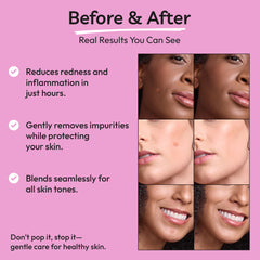 Spot Stoppers Pimple Patches (Pack of 30)